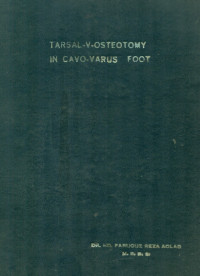 Image of Tarsal-V-Osteotomy In Cavo-Varus Foot