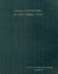 Image of Tarsal-V-Osteotomy In Cavo-Varus Foot
